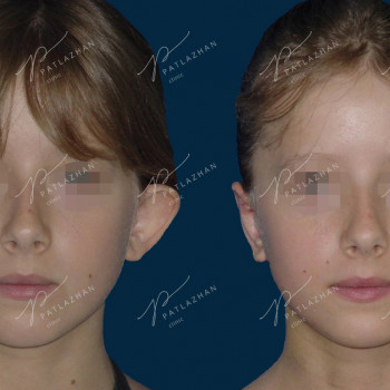 отопластика