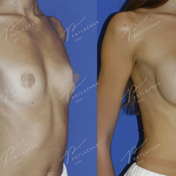 увеличение груди