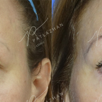 блефаропластика