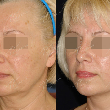 омоложение лица (фейслифтинг)