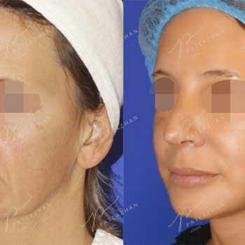 омоложение лица (фейслифтинг)