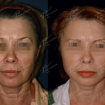 омоложение лица (фейслифтинг)