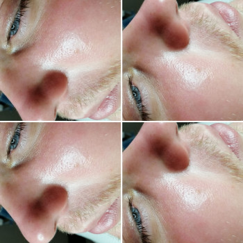 Химический пилинг
                    Косметолог-эстетист Влада Харьков