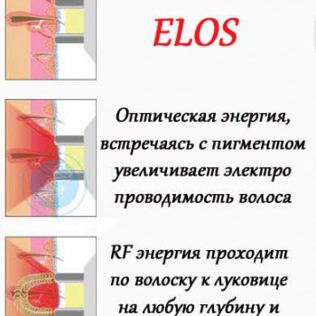 ЕЛОС епіляція (видалення волосся)
                    Косметологічний центр Стиль Лилий Ніжин