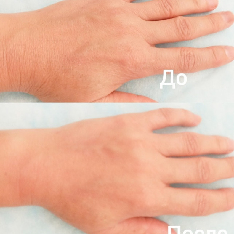 Миофасциальный массаж кистей рук, фото - Косметолог-эстетист Светлана Халаим