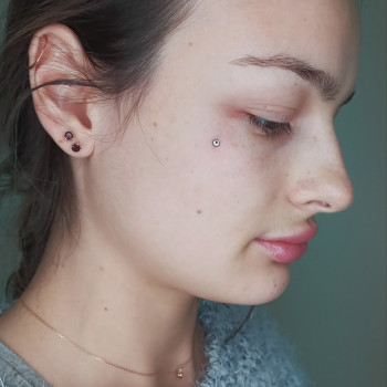 Микродермал на лице