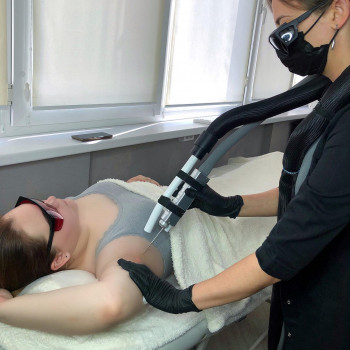 Лазерная эпиляция Александритовым лазером
