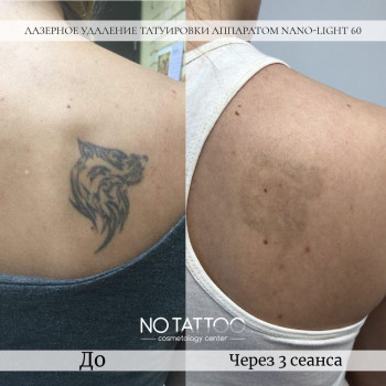 Чистка и пилинг тела 