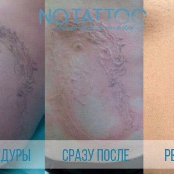 Чистка и пилинг тела 