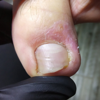 Удаление вросшего ногтя
                    Нігтьова студія Кабинет помощи стопам PodoExpert Харків