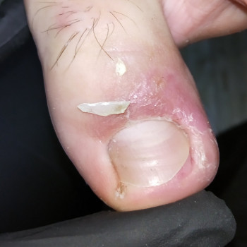 Удаление вросшего ногтя
                    Нігтьова студія Кабинет помощи стопам PodoExpert Харків