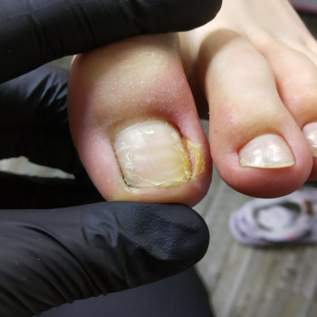 Удаление вросшего ногтя
                    Нігтьова студія Кабинет помощи стопам PodoExpert Харків