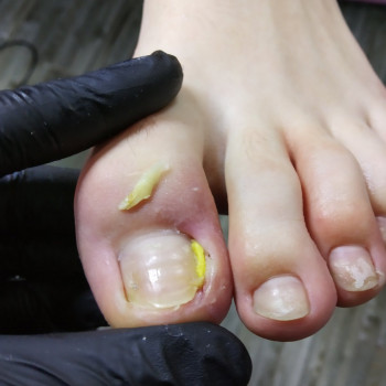 Удаление вросшего ногтя
                    Нігтьова студія Кабинет помощи стопам PodoExpert Харків