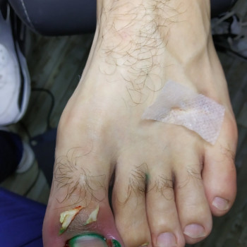 Удаление вросшего ногтя
                    Нігтьова студія Кабинет помощи стопам PodoExpert Харків