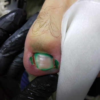 Удаление вросшего ногтя
                    Нігтьова студія Кабинет помощи стопам PodoExpert Харків