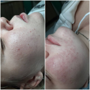 Чистка обличчя
                    Косметолог Альона Борисполь