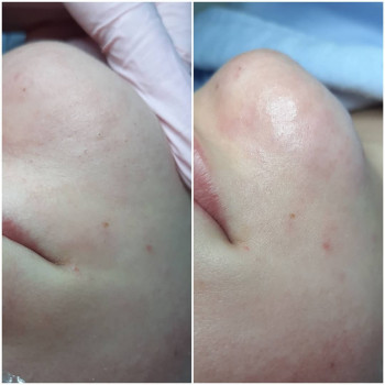 Чистка обличчя
                    Косметолог Альона Борисполь