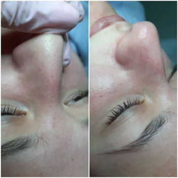 Чистка обличчя
                    Косметолог Альона Борисполь