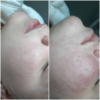 Чистка обличчя
                    Косметолог Альона Борисполь