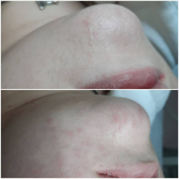 Чистка обличчя
                    Косметолог Альона Борисполь