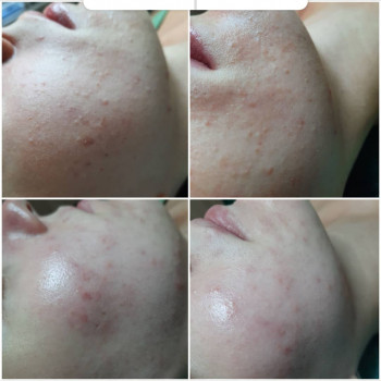 Чистка обличчя
                    Косметолог Альона Борисполь