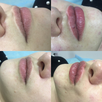 Контурная пластика губ
                    Дерматолог косметолог Алёна Николаев