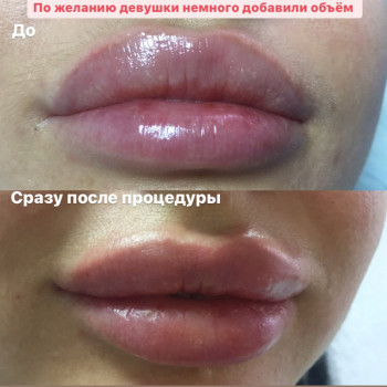 Контурная пластика губ
                    Дерматолог косметолог Алёна Николаев