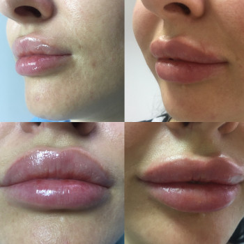 Контурная пластика губ
                    Дерматолог косметолог Алёна Николаев