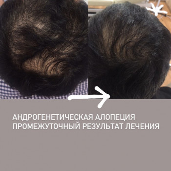 Лечение выпадения волос
                    Дерматолог косметолог Алёна Николаев