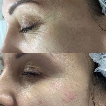 Ботокс, ботулинотерапия
                    Дерматолог косметолог Алёна Николаев