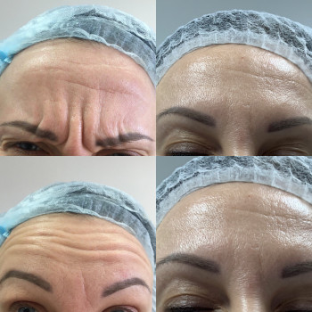 Ботокс, ботулинотерапия
                    Дерматолог косметолог Алёна Николаев