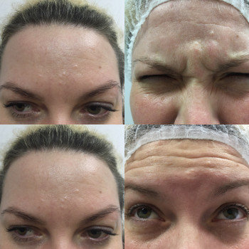 Ботокс, ботулинотерапия
                    Дерматолог косметолог Алёна Николаев