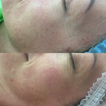 Биоревитализация
                    Дерматолог косметолог Алёна Миколаїв