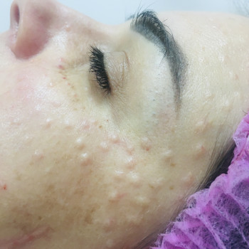 Биоревитализация
                    Дерматолог косметолог Алёна Миколаїв