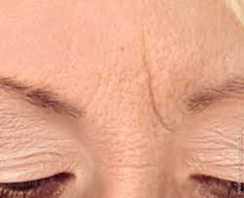 межбровная складка. межбровная морщина. вертикальные морщины между бровями. межбровная складка. межбровная морщина.