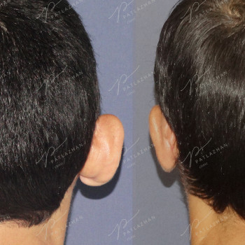 Двусторонняя отопластика с коррекцией асимметрии ушных раков