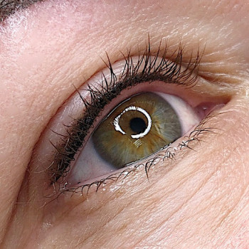 межресничка