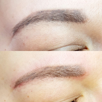 удаление татуажа