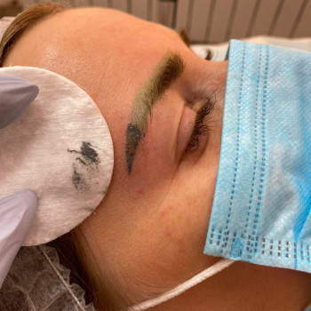 удаление татуажа