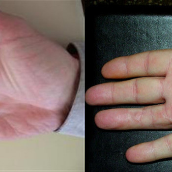 Донтрактура Дюпюитрена До После