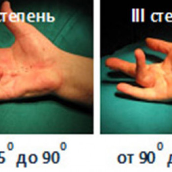 Степени контрактур Дюпюитрена