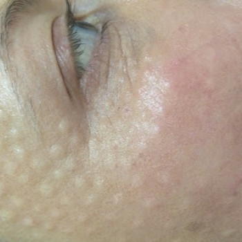 Биоревитализация – это инъекционная методика омоложе