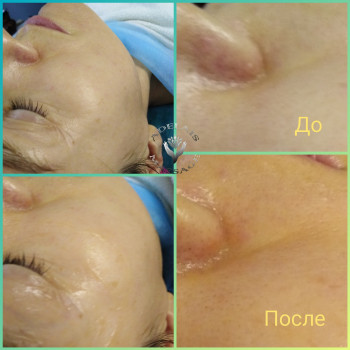 Результат одной процедуры