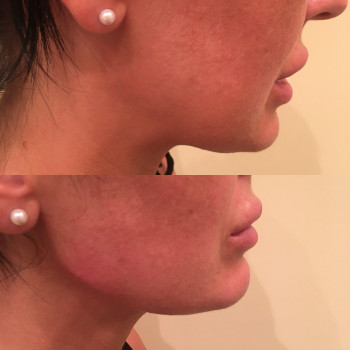 Корекція кутів щелепи (Джолі).