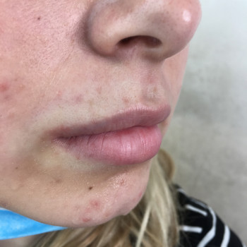 Корекція форми губ, до процедури.