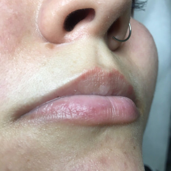 Корекція форми губ, до процедури.