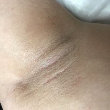 Шугаринг зоны подмышек