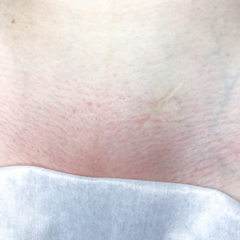 Шугаринг зоны бикини.