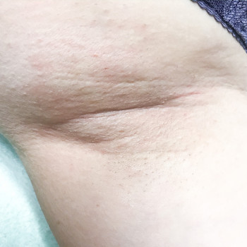 Шугаринг зоны подмышек