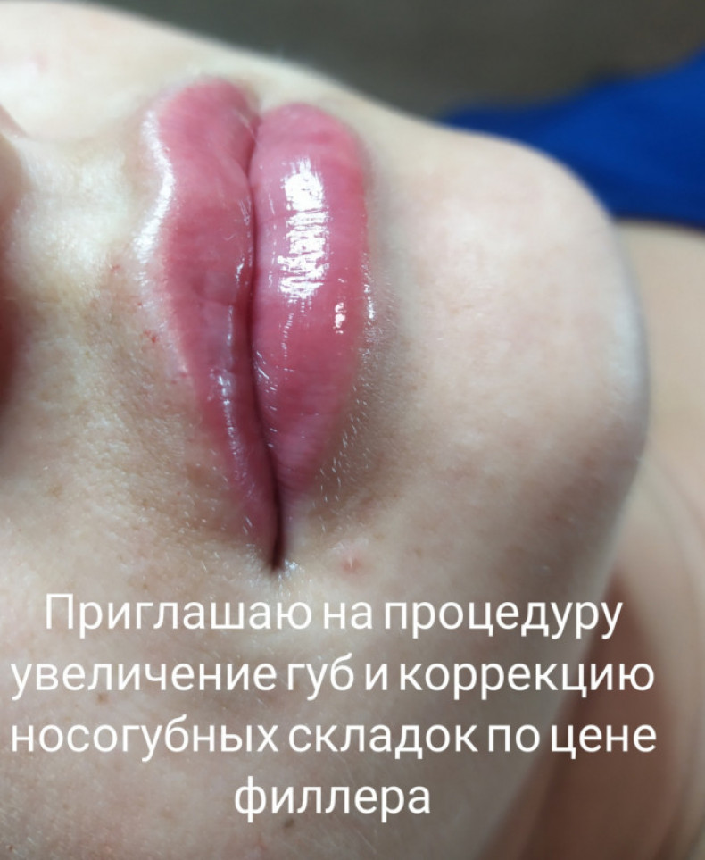 Увеличение губ филлером на основе гиалуроновой кислоты, фото -  